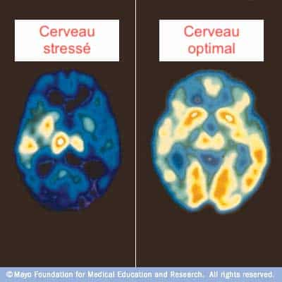 Effet du stress sur le cerveau
